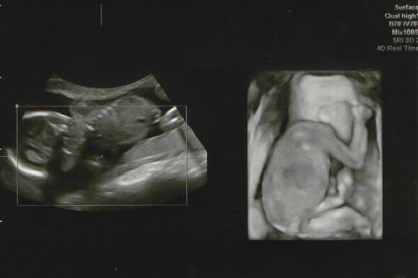 助産師監修 妊娠中のエコー写真について 3dと4dの違いは